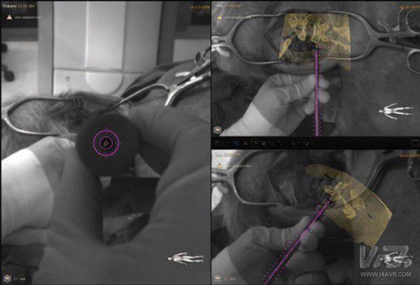 飞利浦转战健康业务 VR技术助力脊柱外科手术